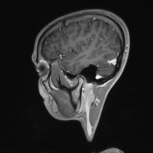 Basilar artery perforator aneurysm (Radiopaedia 82455-97733 G 31).jpg