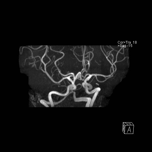 Basilar tip aneurysm (Radiopaedia 26504-26632 D 34).jpg