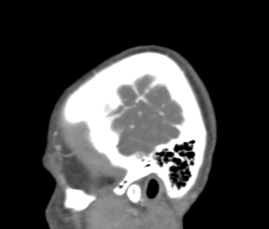 Basilar tip aneurysm with coiling (Radiopaedia 53912-60086 C 6).jpg