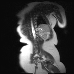 File:Beckwith-Wiedeman syndrome with bilateral Wilms tumors (Radiopaedia 60850-69233 B 2).jpg