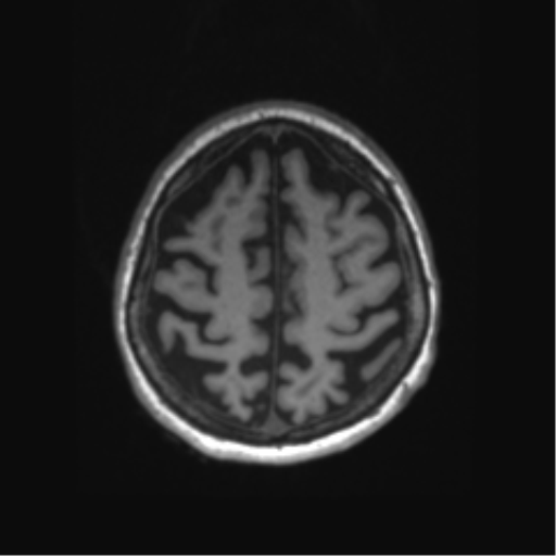 Behavioral variant frontotemporal dementia and late onset schizophrenia (Radiopaedia 52197-58083 Axial T1 13).png