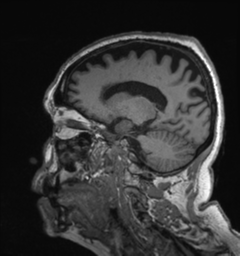 Behavioral variant frontotemporal dementia and late onset schizophrenia (Radiopaedia 52197-58083 Sagittal T1 64).png