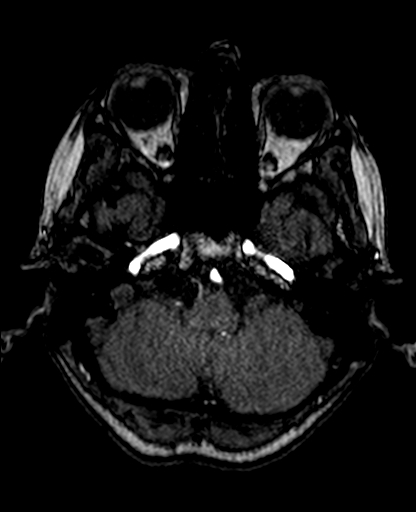 File:Berry aneurysm of the terminal internal carotid artery (Radiopaedia 88286-104918 Axial TOF 66).jpg