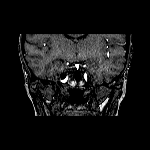 Berry aneurysm of the terminal internal carotid artery (Radiopaedia 88286-104918 Coronal TOF 46).jpg