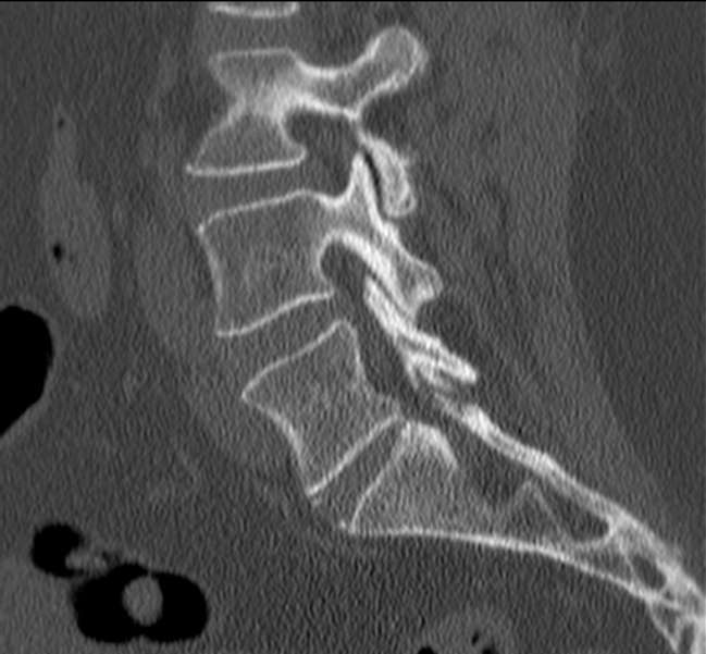 Bertolotti syndrome (Radiopaedia 24864-25128 Sagittal bone window 35).jpg