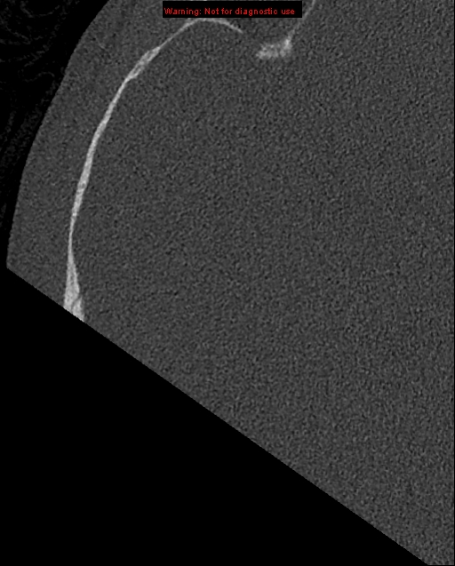 Bezold abscess (Radiopaedia 21645-21605 bone window 3).jpg