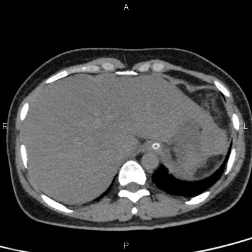 Bilateral adrenal gland hyperenhancement in pancreatitis (Radiopaedia 86642-102753 Axial non-contrast 15).jpg