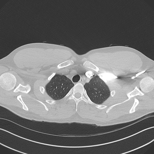 Bilateral atelectasis (Radiopaedia 48666-53675 Axial lung window 11).jpg