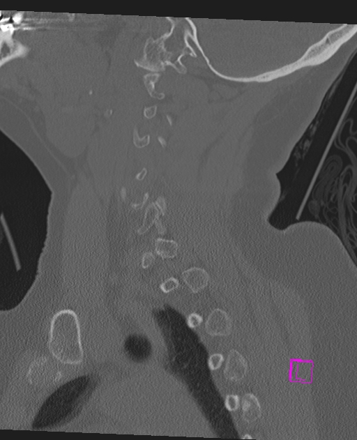 Bilateral atlanto-occipital assimilation (Radiopaedia 28350-28603 Sagittal bone window 24).jpg