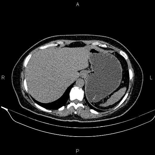 Bilateral benign adrenal adenomas (Radiopaedia 86912-103124 Axial non-contrast 24).jpg