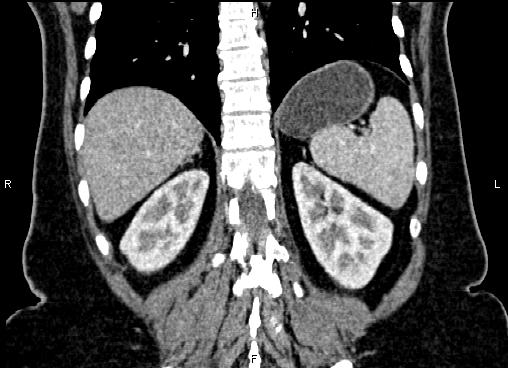 Bilateral benign adrenal adenomas (Radiopaedia 86912-103124 D 48).jpg
