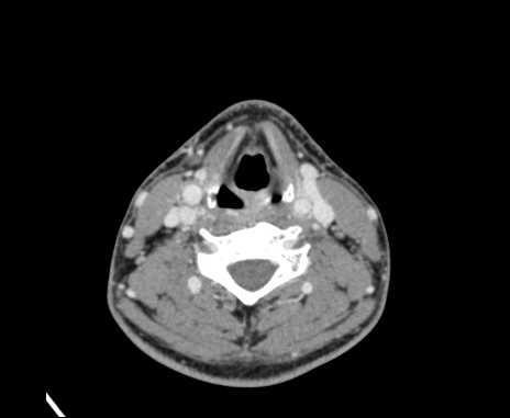 Bilateral carotid body tumors (Radiopaedia 61841-69870 Axial Post contrast 66).jpg