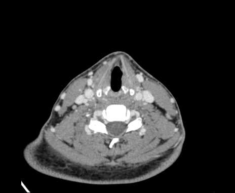 Bilateral carotid body tumors (Radiopaedia 61841-69870 Axial Post contrast 72).jpg