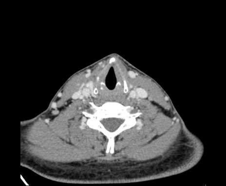 Bilateral carotid body tumors (Radiopaedia 61841-69870 Axial Post contrast 77).jpg