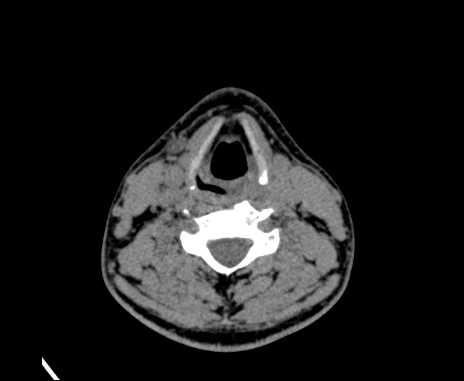 Bilateral carotid body tumors (Radiopaedia 61841-69870 Axial non-contrast 65).jpg