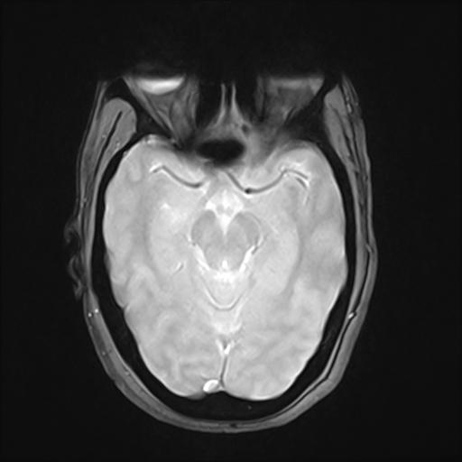 File:Bilateral carotid body tumors and right jugular paraganglioma (Radiopaedia 20024-20060 Axial 87).jpg