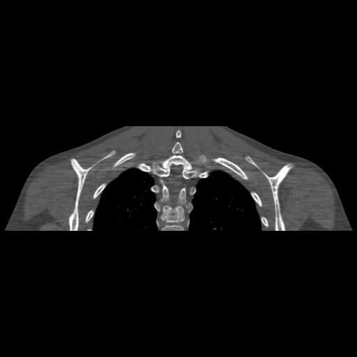 Bilateral chronic posterior shoulder dislocation (Radiopaedia 39213-41452 Coronal bone window 46).jpg