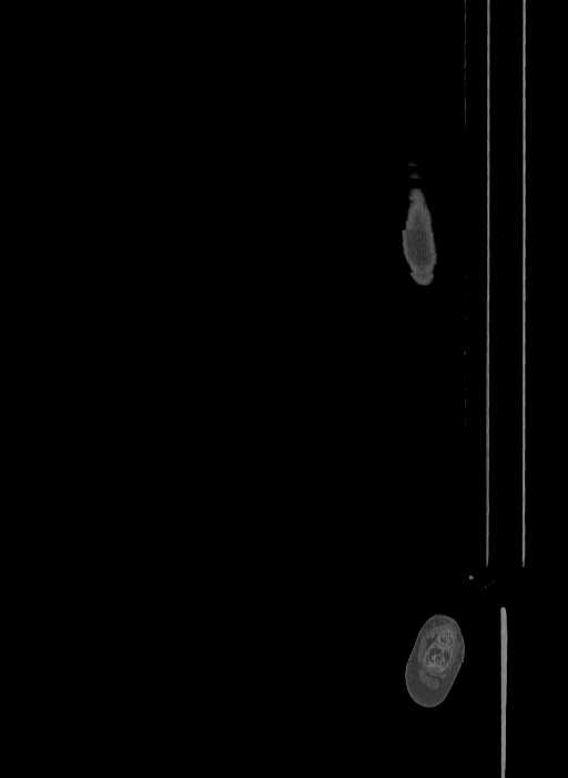 Bilateral fibular hemimelia type II (Radiopaedia 69581-79491 Sagittal bone window 16).jpg