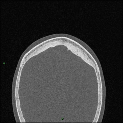 File:Bilateral frontal mucoceles (Radiopaedia 82352-96454 Axial bone window 12).jpg