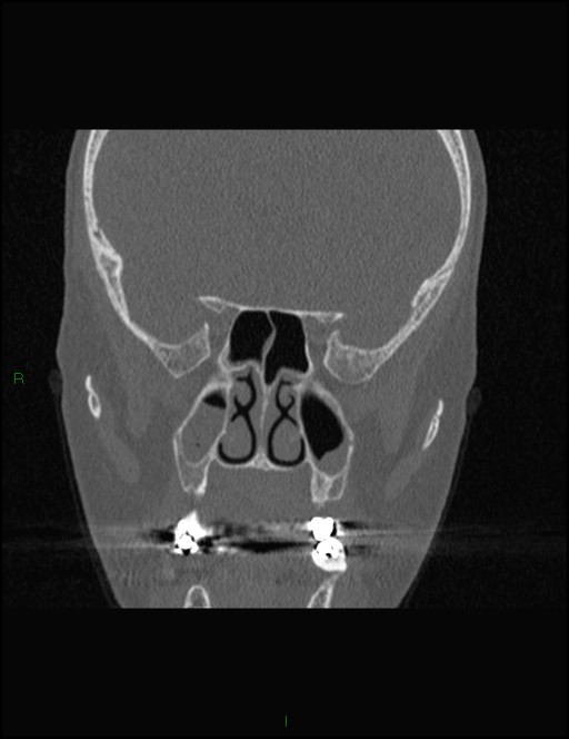 Bilateral frontal mucoceles (Radiopaedia 82352-96454 Coronal 185).jpg