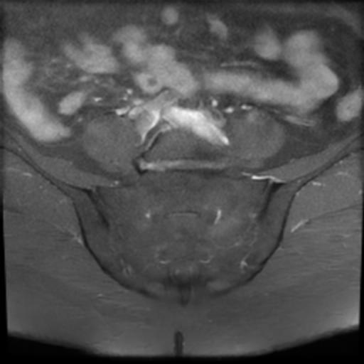 File:Bilateral ovarian dermoid cysts (Radiopaedia 90152-107338 Axial T1 C+ fat sat 2).jpg