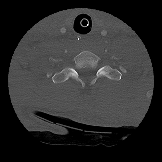 Bilateral perched facets with cord injury (Radiopaedia 45587-49713 Axial bone window 88).jpg