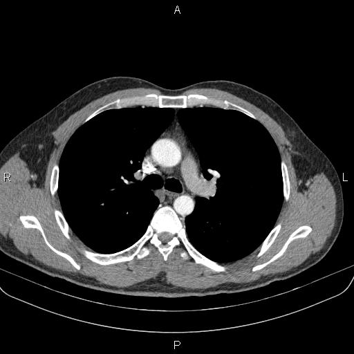 File:Bilateral pulmonary AVM (Radiopaedia 83134-97505 A 28).jpg