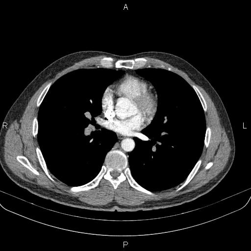 Bilateral pulmonary AVM (Radiopaedia 83134-97505 A 41).jpg