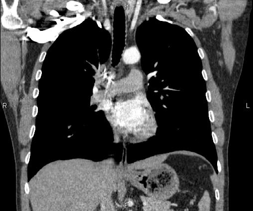 Bilateral pulmonary AVM (Radiopaedia 83134-97505 C 38).jpg