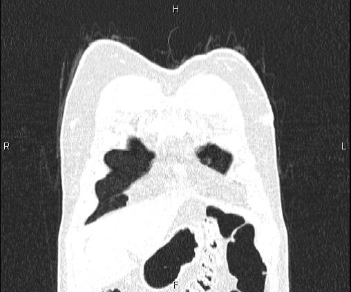 Bilateral pulmonary AVM (Radiopaedia 83134-97505 Coronal lung window 16).jpg