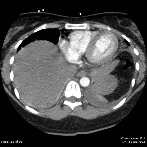 Bilateral pulmonary emboli with Hampton hump sign (Radiopaedia 54070-60246 Axial C+ CTPA 55).jpg