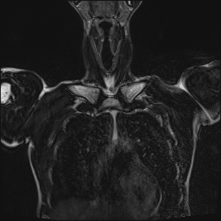 Bilateral spinoglenoid notch ganglion cysts (Radiopaedia 29577-30082 Coronal T2 26).jpg