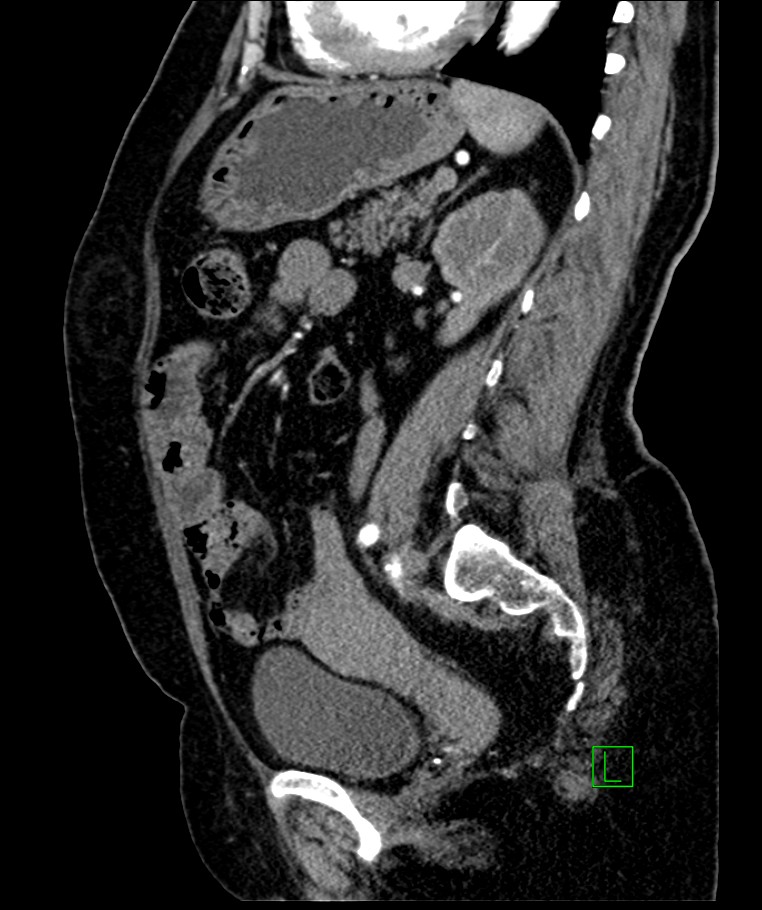 Bilateral sporadic synchronous clear cell renal cell carcinoma (Radiopaedia 85035-100575 E 52).jpg