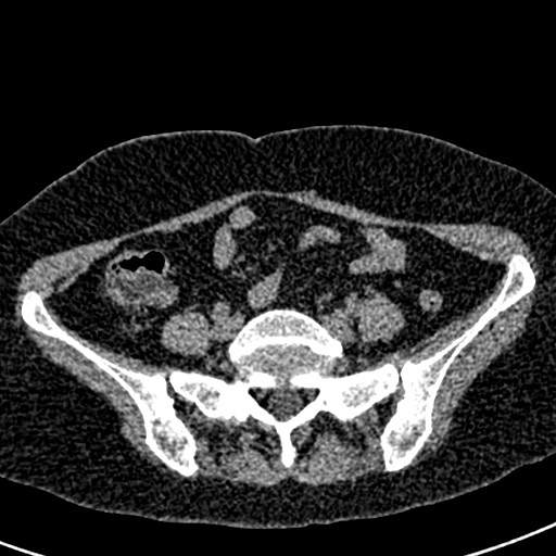 Bilateral staghorn calculi (Radiopaedia 59475-66842 Axial non-contrast 54).jpg