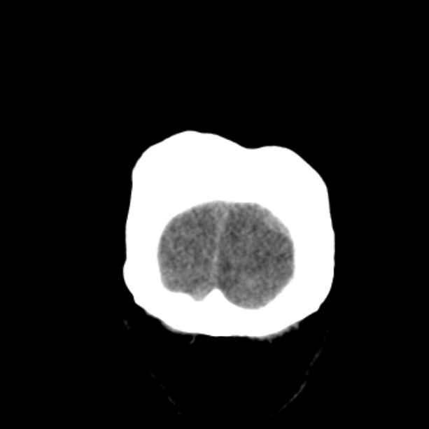 Bilateral subdural hemorrhages (Radiopaedia 26588-26732 Coronal non-contrast 58).jpg