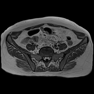 Bilateral tubo-ovarian abscesses (Radiopaedia 58635-65829 Axial T1 C+ 9).jpg