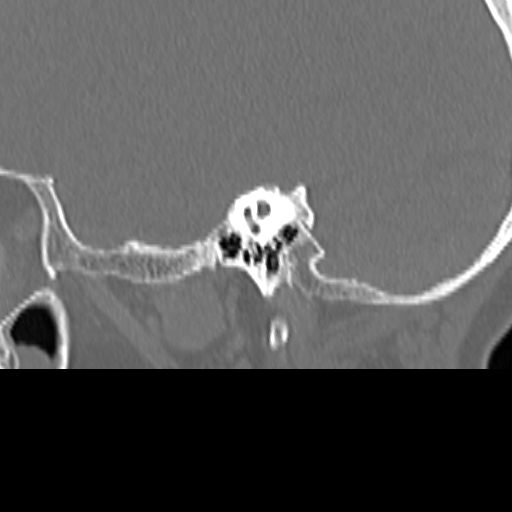 Bilateral tympanoplasty (Radiopaedia 16947-16664 Sagittal bone window 43).jpg