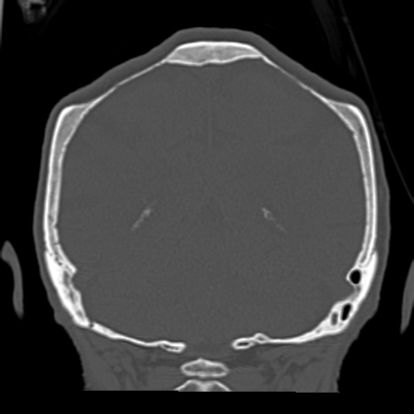 Biparietal osteodystrophy (Radiopaedia 46109-50463 Coronal bone window 78).jpg