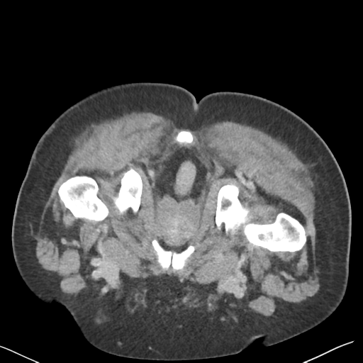 File:Bladder papillary urothelial carcinoma (Radiopaedia 48119-52951 Axial C+ delayed 61).png