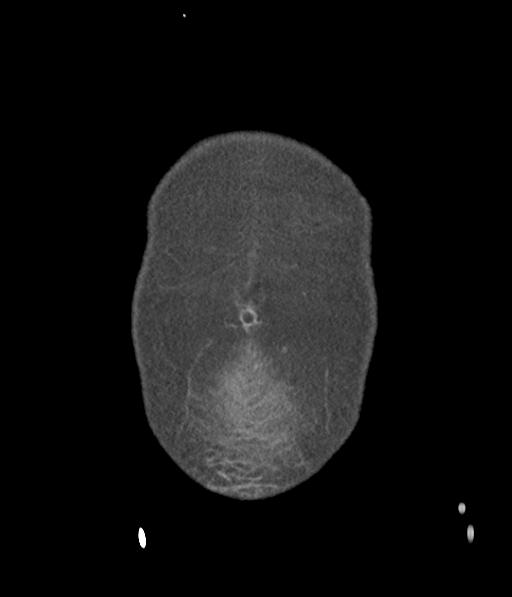 Bladder rupture post renal biopsy (Radiopaedia 30863-31572 Coronal non-contrast 6).jpg