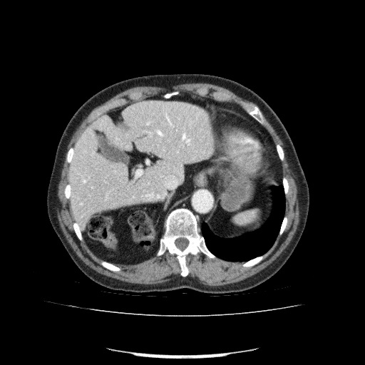 File:Bladder tumor detected on trauma CT (Radiopaedia 51809-57609 B 30).jpg