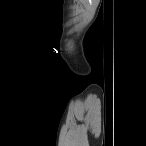 Blunt abdominal trauma with solid organ and musculoskelatal injury with active extravasation (Radiopaedia 68364-77895 C 15).jpg