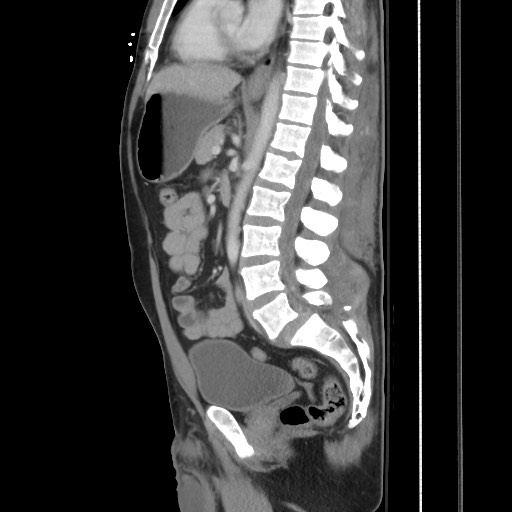 Blunt abdominal trauma with solid organ and musculoskelatal injury with active extravasation (Radiopaedia 68364-77895 C 79).jpg