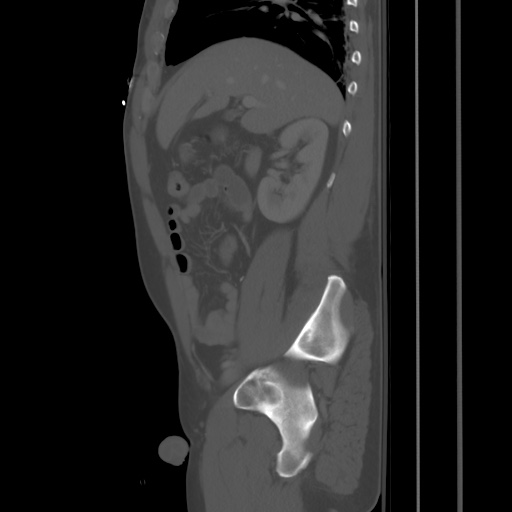 Blunt abdominal trauma with solid organ and musculoskelatal injury with active extravasation (Radiopaedia 68364-77895 Sagittal bone window 29).jpg