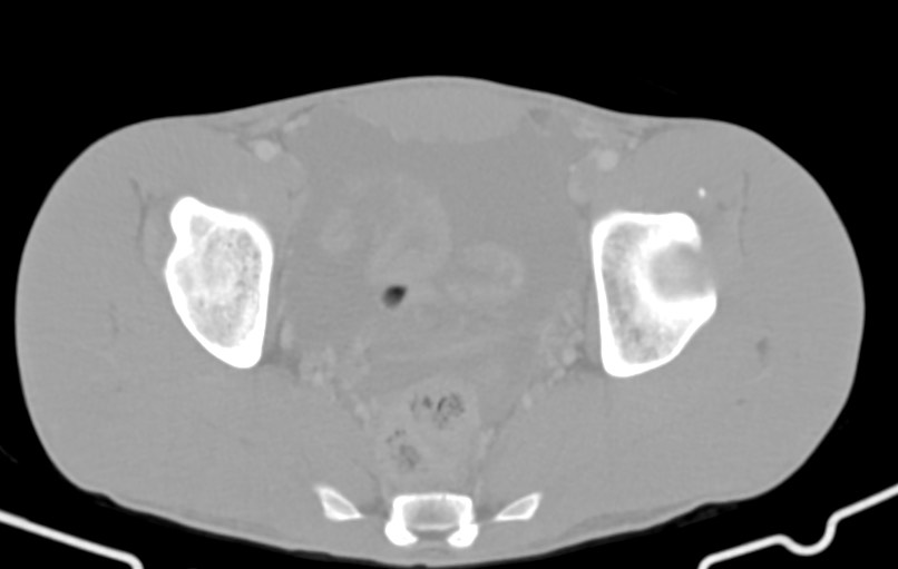 Blunt injury to the small bowel (Radiopaedia 74953-85987 Axial Wide 86).jpg
