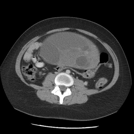 File:Borderline mucinous tumor (ovary) (Radiopaedia 78228-90808 A 97).jpg