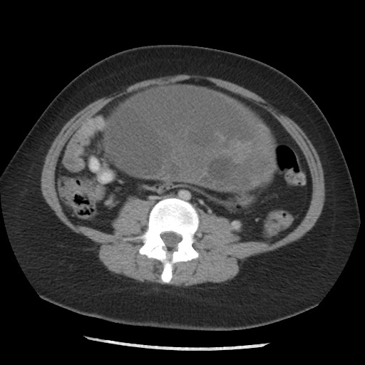 Borderline mucinous tumor (ovary) (Radiopaedia 78228-90808 A 98).jpg