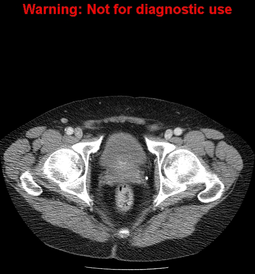 File:Bosniak renal cyst - type IV (Radiopaedia 23402-23466 D 78).jpg