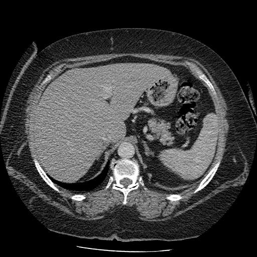 Bovine aortic arch - right internal mammary vein drains into the superior vena cava (Radiopaedia 63296-71875 A 167).jpg
