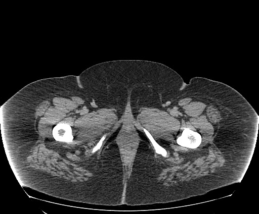 Bowel and splenic infarcts in acute lymphocytic leukemia (Radiopaedia 61055-68913 A 133).jpg